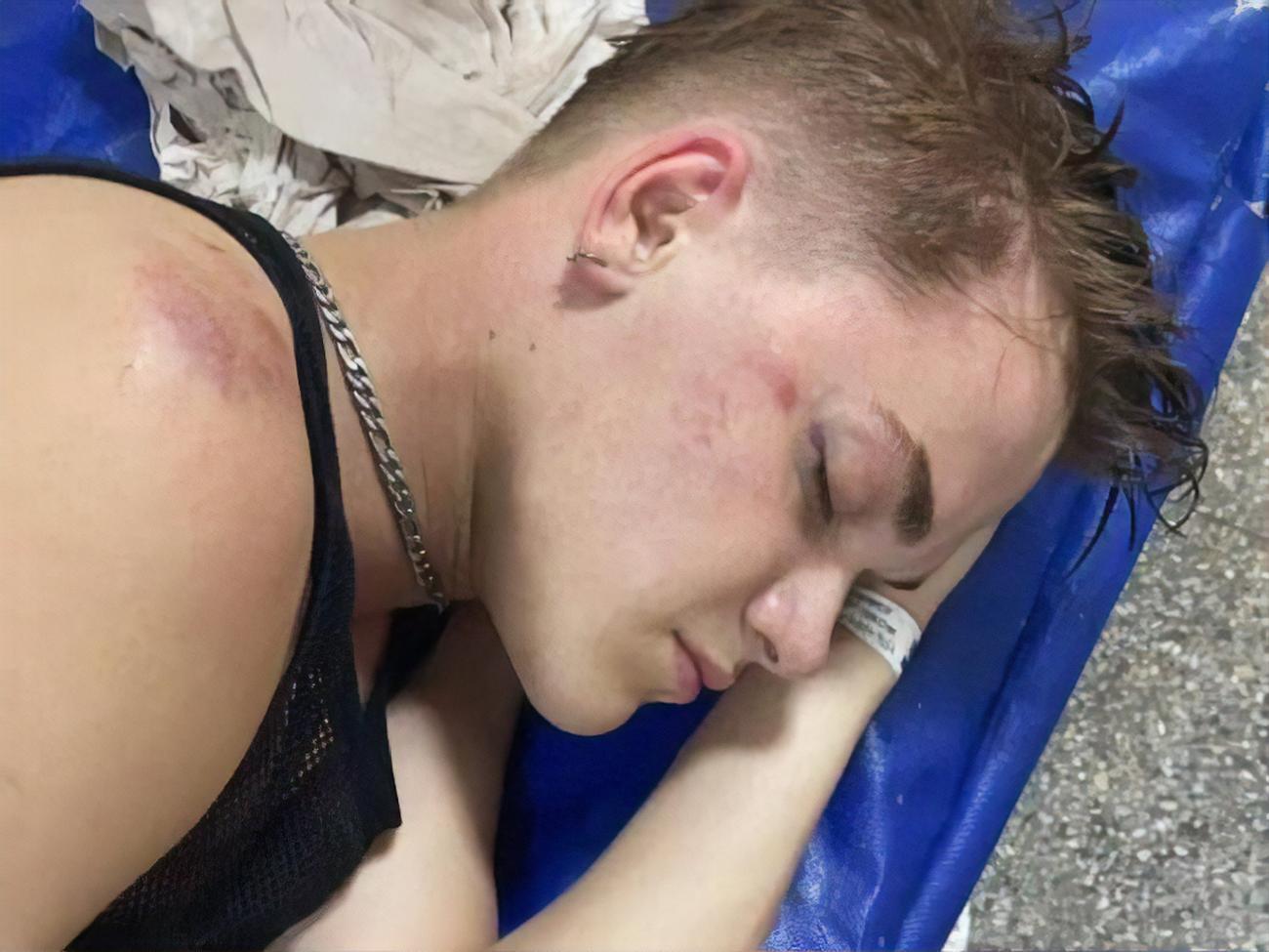 Танцюриста Гончаренка ввели в медикаментозну кому