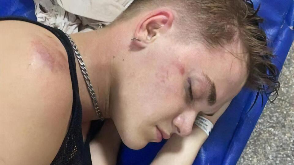 Танцора Гончаренко ввели в медикаментозную кому