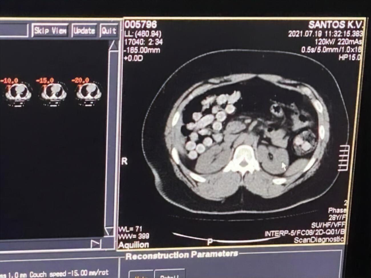 У задержанного в кишечнике оказалось 90 капсул с наркотиком