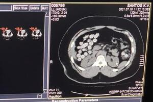 У задержанного в кишечнике оказалось 90 капсул с наркотиком
