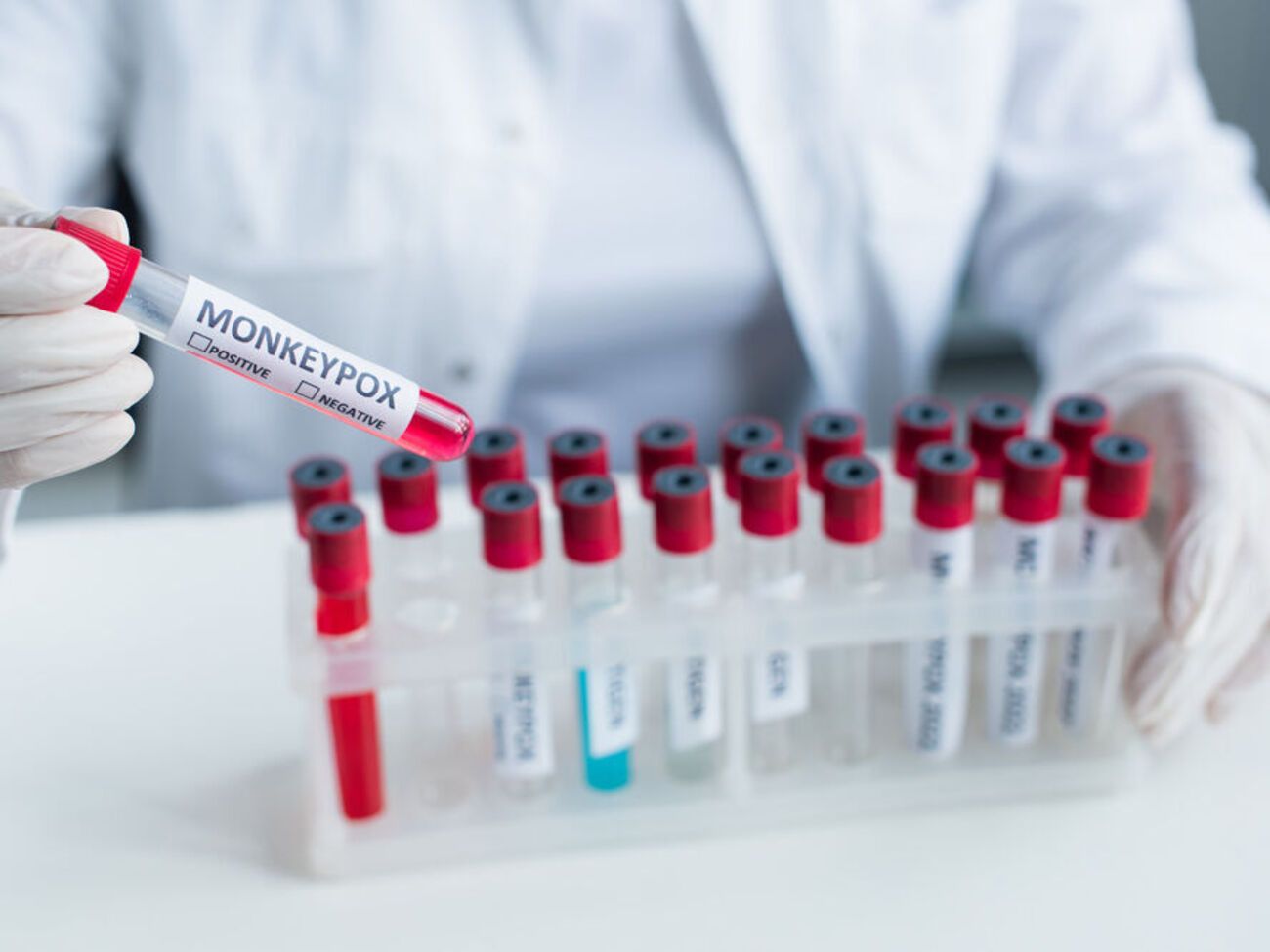 Усі випадки віспи мавп, виявлені в Україні, не пов'язані між собою