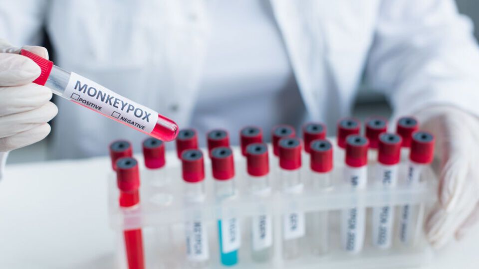 Все случаи оспы обезьян, выявленные в Украине, не связаны между собой