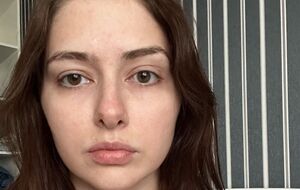 Тишкевич: МРТ показала динаміку змін у мозку