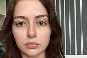 Тышкевич: МРТ показало динамику изменений в мозге