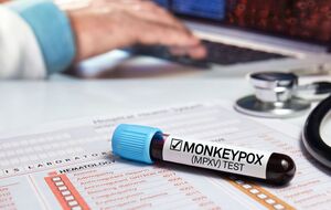 У США зафіксовано перший випадок смерті від віспи мавп