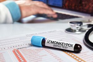 У США зафіксовано перший випадок смерті від віспи мавп