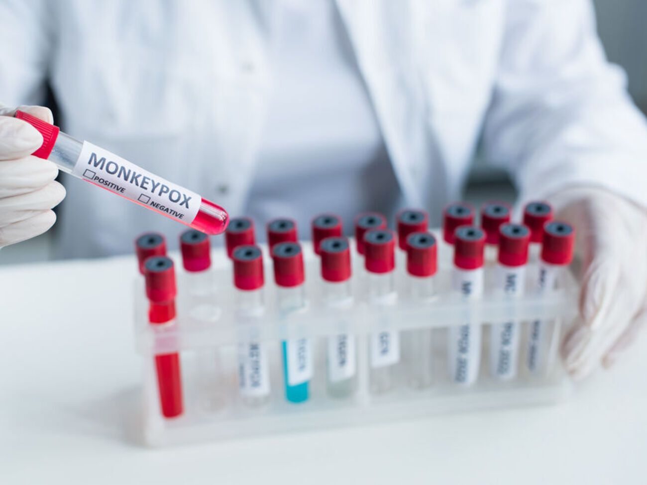 Віспу мавп у пацієнта підтвердили за допомогою ПЛР-тесту