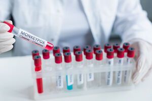 Віспу мавп у пацієнта підтвердили за допомогою ПЛР-тесту