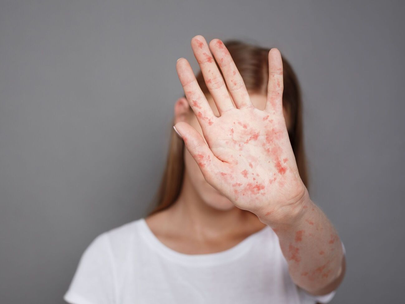 С начала года в Украине выявили 55 случаев кори, отметили в Минздраве