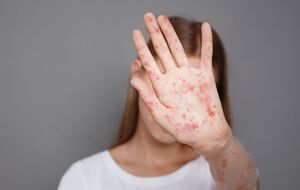 С начала года в Украине выявили 55 случаев кори, отметили в Минздраве