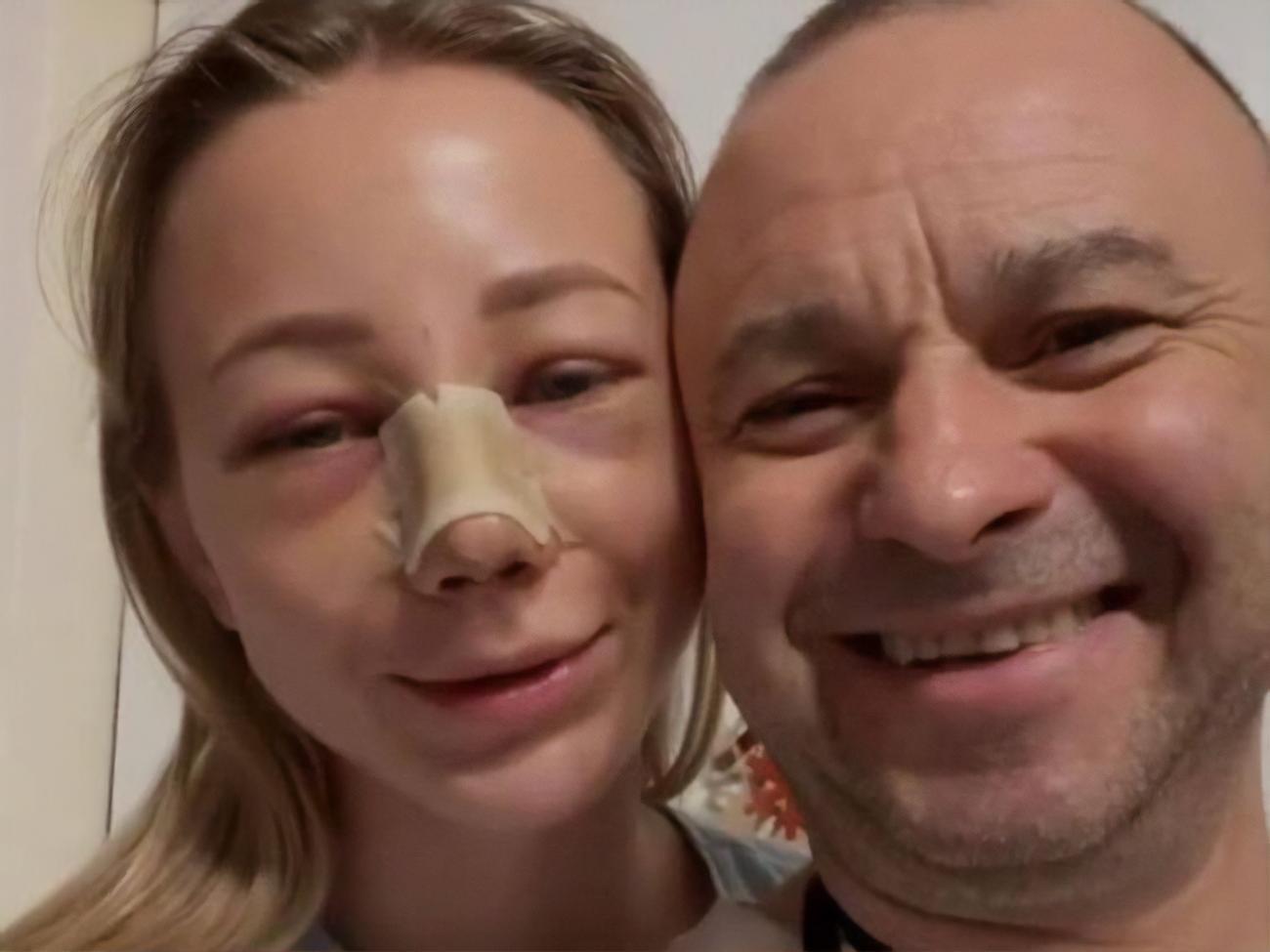 Дружина Павліка показала, який вигляд має після ринопластики, і зізналася, що хоче зробити корекцію грудей у майбутньому