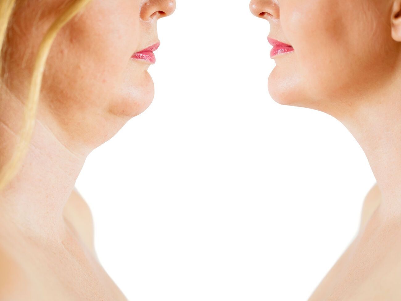 Избавиться от второго подбородка в том числе поможет массаж