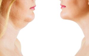 Избавиться от второго подбородка в том числе поможет массаж