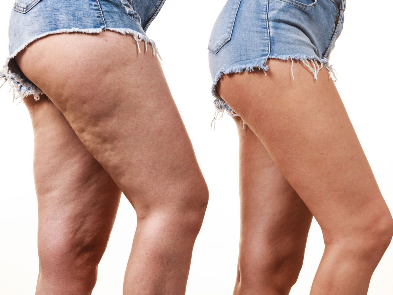 Усунути проблему в'ялої й бугристої шкіри допоможуть збалансоване харчування з дефіцитом енергії і фізичні вправи