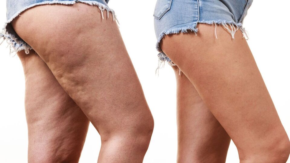 Усунути проблему в'ялої й бугристої шкіри допоможуть збалансоване харчування з дефіцитом енергії і фізичні вправи