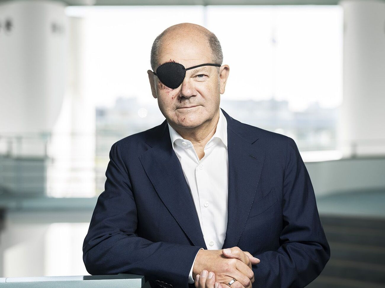 Шольц упал во время пробежки и показал, как выглядит на следующий день после несчастного случая