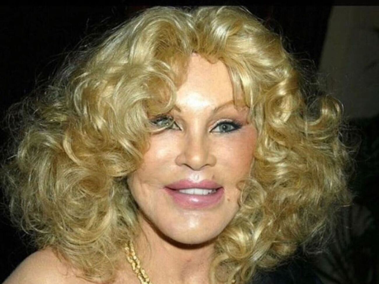 Хірургічний шлях Вільденштейн почався з підтяжки очей