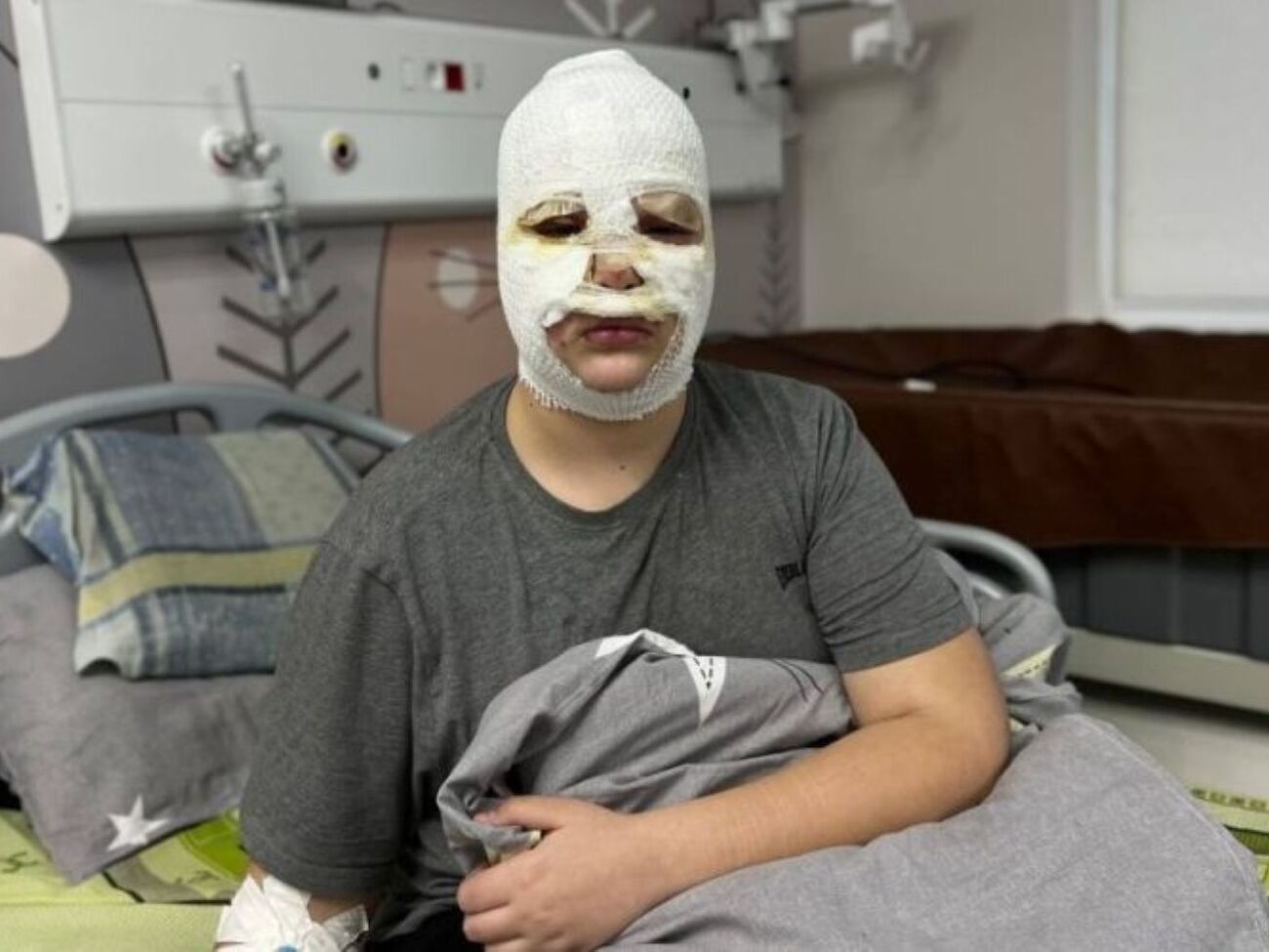 У всіх дітей, які вже потрапили до лікарні, залишаться рубці на обличчі, зазначили в Першому медоб'єднанні