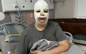 У всех детей, которые уже попали в больницу, останутся рубцы на лице, отметили в Первом медобъединении