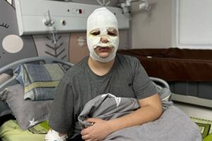 У всех детей, которые уже попали в больницу, останутся рубцы на лице, отметили в Первом медобъединении