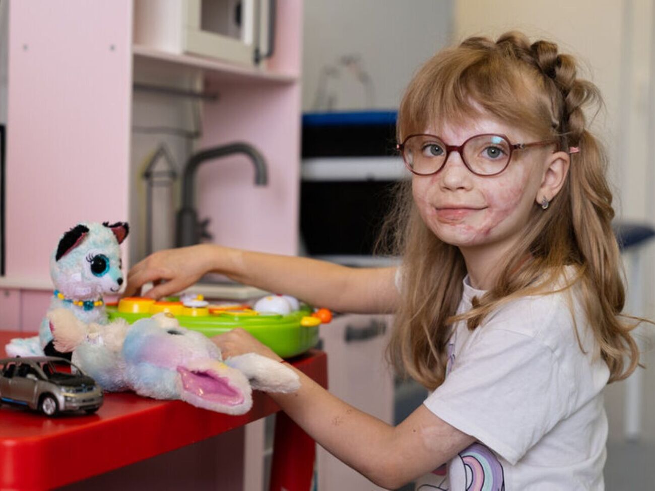 Ребенок получил ожоги 30% тела