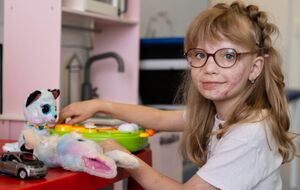 Ребенок получил ожоги 30% тела