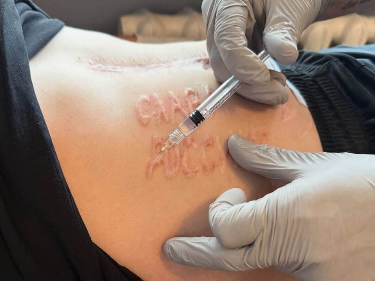 Убирать надпись будут лазерами