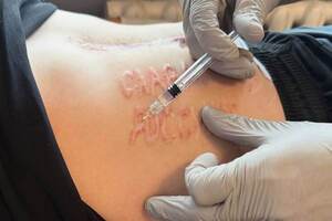 Прибирати напис будуть лазерами