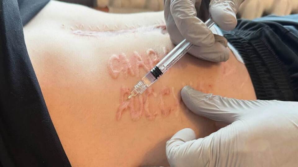 Убирать надпись будут лазерами