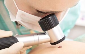 Щорічно меланому діагностують приблизно в 17,5 тис. людей