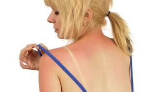 Врач рассказала об опасности загара