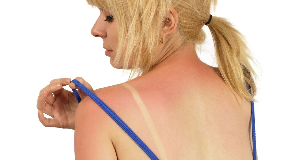 Врач рассказала об опасности загара