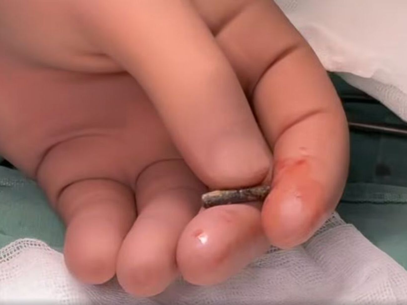 Медики достали пулю из сердца