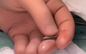 Медики достали пулю из сердца