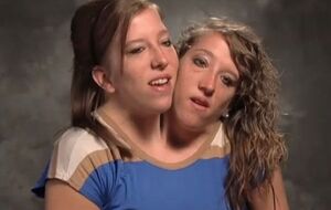 У сиамских близнецов редкое заболевание, известное как дицефалический парапаг