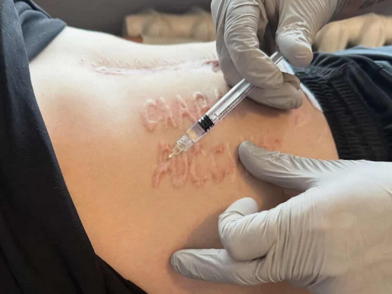 ЗМІ з'ясували, хто з хірургів міг випалити напис на тілі