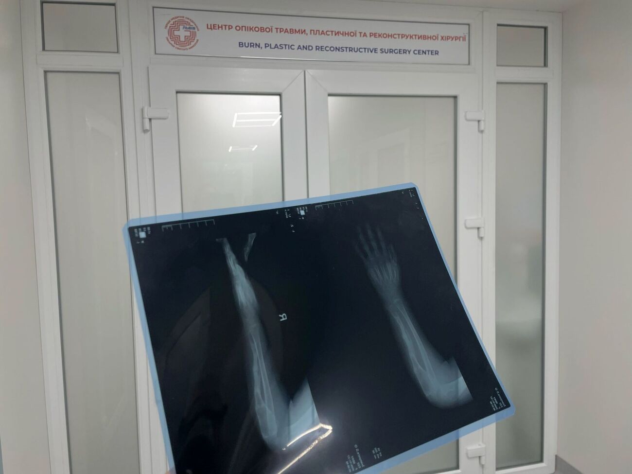 Фахівці провели дитині низку операцій