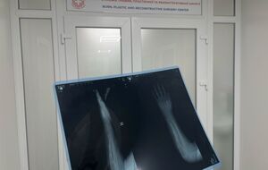 Фахівці провели дитині низку операцій