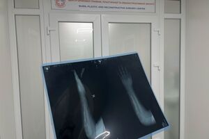 Фахівці провели дитині низку операцій